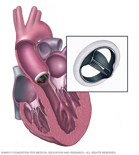 Heart valve replacement surgery